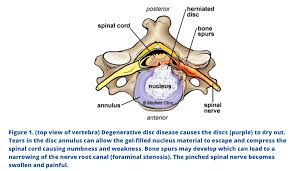 Injuries to the scapula are usually from an the clavicle attaches to several muscles connecting it to the arm, the chest and the neck. Artificial Cervical Disc Surgery Treatments Complications And Outcomes