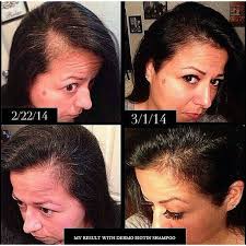 Before And After Biotin Shampoo For Hair Growth Natural Shampoo For Hair Loss Biotin Shampoo Hair Skin Nails Hair Skin Healthy Shiny Hair