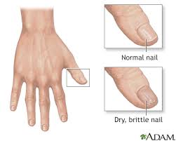 Nail Abnormalities Information Mount Sinai New York