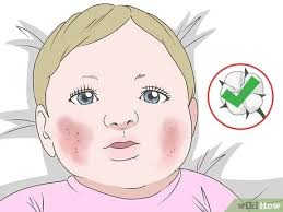 Read my story to see what worked and what changed my life. 3 Ways To Get Rid Of Baby Acne Wikihow