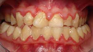 Blog Waverley Oaks Dental Gum Disease Healthy Teeth Dental