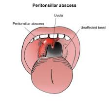 Image result for Peritonsillar Abscess
