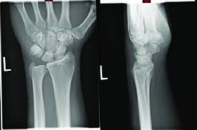 Image result for Pisiform Bone