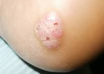 When a bone tumor grows, it presses on healthy bone tissue and can destroy it, which causes the following symptoms: Cancer Foot Care Group