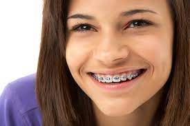 Many patients picture beautiful, white teeth when their braces come off. How To Keep Your Teeth White With Braces Thomas Orthodontics