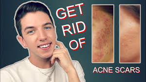 Try to avoid touching your face at all. How To Get Rid Rid Of Acne Scars Completely Youtube