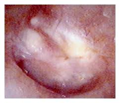 Image result for Myringosclerosis