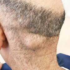 Lipom Liposarkom Ursache Symptome Diagnose Entfernung
