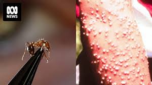 Image result for Fire Ant Sting