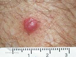 Merkel cell carcinoma is a skin cancer characterized by uncontrolled and abnormal growth of merkel cells in the skin. Skin Cancer Image Gallery Pictures And Photos