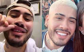 Kevinho divertiu seus seguidores ao aparecer em alguns stories sem lente de contato dos dentes (imagem em destaque). Lente De Contato Dental Conheca O Procedimento Feito Pelo Cantor Kevinho