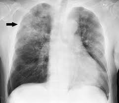 There are also important structures that are obscured or become visible. Pneumonia Wikipedia