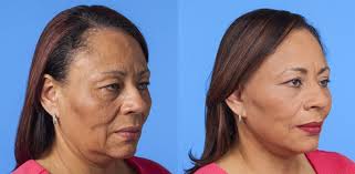 Before And After Sono Bello Total Body Transformation Centers Image Source Sono Bello Website Transformation Body Sonobello Muscle Body