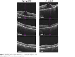 Or…can i document, ou 20/20? A Novel Intravitreal Fluocinolone Acetonide Implant Iluvien In Opth