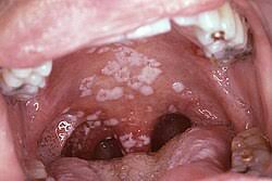Image result for Candidiasis