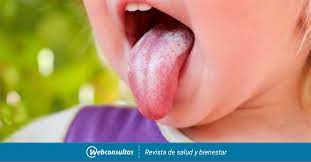 Tratamiento Del Muguet Oral En Bebes Bebes Y Ninos