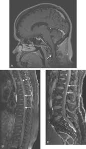 What is metastatic liver cancer? Breast Cancer Metastases To The Neural Axis Clinical Gate