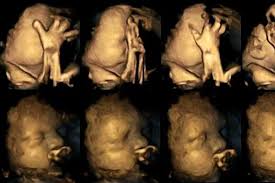Clinical cases from the practice of an endocrinologist / t. Study Shows Harmful Effects Of Smoking During Pregnancy