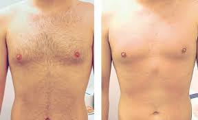 Pubic hair removal is a hot topic among the current generation in india, where the smoothness of the skin and hygiene is preferred over the presence of excess hair. 8 Before And After Laser Hair Removal Ideas Laser Hair Removal Treatment Laser Hair Removal Hair Removal