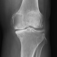 Arthrose Les Solutions Pour Soulager La Douleur Regenerer Ou Reparer Le Cartilage Dr Philippe Loriaut Chirurgien Orthopediste Paris