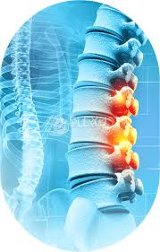 Image result for Myelitis