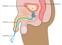 Image result for Bladder Irrigation