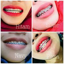 Selamat datang di di website kami, kami menjual alat alat behel dengan harga yang murah dengan kwalitas yang bagus, kami menjual seperti lem behel orthoforce, lem behel light cure, lem behel gc fuji ortho, sonde, kawat niti, bracket behel, laser behel (led curing), bucaltube, wax (pencegah sariawan). Behel Power Chain Box Karet Shopee Indonesia