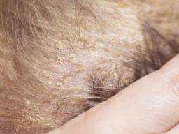 Dandruff or seborrheic dermatitis is a common scalp condition that causes itchiness and scaling. Seborrheic Dermatitis Hair Loss Causes And Treatment