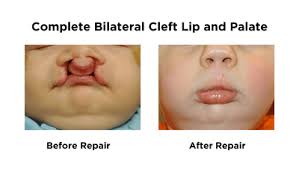 Image result for Cleft Lip