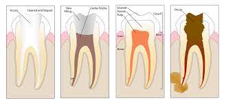 Root Canal Treatment Langley Endodontics Root Canal Specialists
