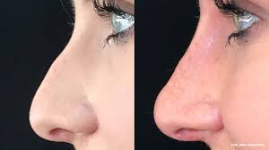 Hi,thank you for your question.generally speaking, fillers take about 2 weeks to set or settle. Nonsurgical Rhinoplasty What To Expect Cost Recovery And More
