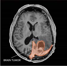 This color is a symbol of childhood cancer (alternative color: Meningioma Diagnosis And Treatment National Cancer Institute