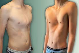 Image result for Pectus Excavatum