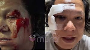 Dahi, Pipi Koyak Akibat Kemalangan...Rakan Selebriti & Peminat Titip Doa  Buat Ronnie Hussein