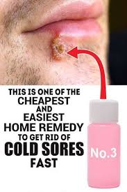 This Is One Of The Cheapest And Easiest Home Remedy To Get Rid Of Cold Sores Fast Cold Home Remedies Home Remedies Cold Sores Cold Sore