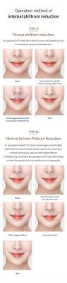 Lamiche Plastic Surgery Internal Philtrum Reduction I happened to know of a term philtrum, but. lamiche plastic surgery internal