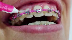 Braces Fetish - Porn Video Clips For Sale at iWantClips - Page 3