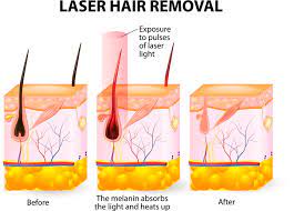 Mild swelling around the hair follicles Laser Hair Removal Cost Side Effects Reviews New Idea Magazine