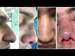 Pin On Rhinoplasty In Pakistan