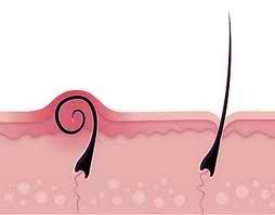 Some people have symptoms of pus inside the bumps of ingrown hair. Stop Ingrown Hair With Kalo Body4real