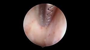 Removal for a patient with an intrauterine pregnancy. Embedded Iud Hysteroscopic Removal Sonia Rebeles Md Facog Youtube