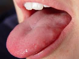 Cutting off swollen taste buds. Swollen Taste Buds Causes Diagnosis And Treatment