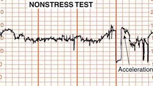 Nst, kardiyotokografi cihazı yardımıyla anne karnındaki fetüsünün kalp atışlarını dinleyerek iyilik halinin değerlendirilmesidir. Dogum Sancisi Nst De Kac Cikar Nst De Sanci Cikmasi Nst 80 100