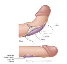 Penile shortening procedures - Patient Information