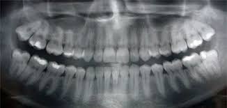 You should consult the manual of the equipment manufacturer for more exact angulati. Do X Rays At The Dentist Cause Cancer