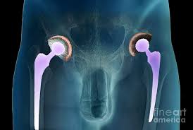 Image result for Hip XRay