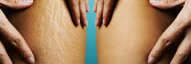 Stretch Marks Treatment in Natick, MA - Cosmetic Dermatology