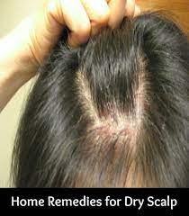 Home Remedies For Dry Scalp Scalp Acne Dry Scalp Remedy Scalp Scabs