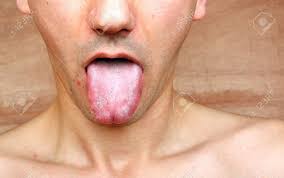 Lengua Infeccion De La Enfermedad La Garganta A Un Hombre Fotos Retratos Imagenes Y Fotografia De Archivo Libres De Derecho Image 34968855