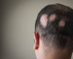 Imagem de Alopecia areata